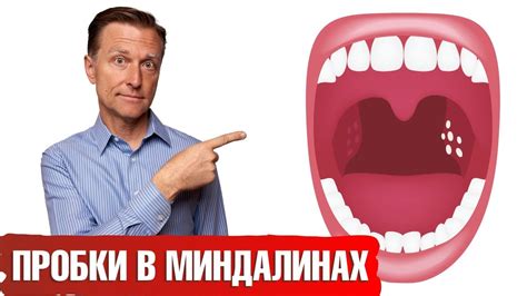 Симптомы белых налетов на миндалинах