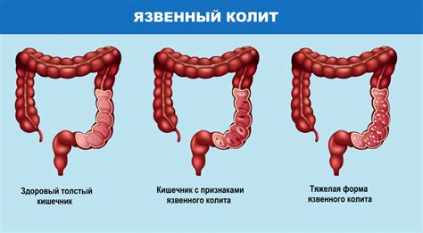 Симптомы колита