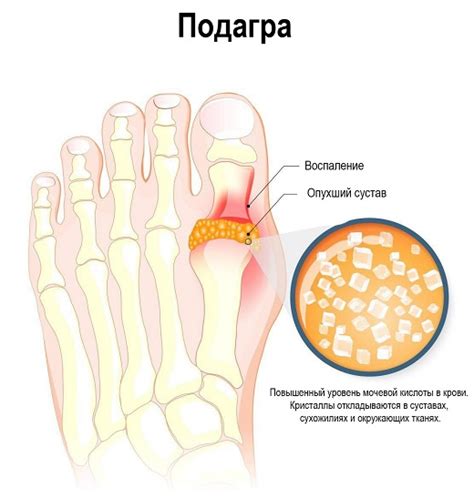 Симптомы подагры в контексте икры