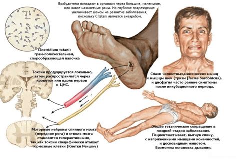 Симптомы столбняка