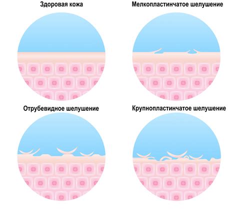 Симптомы шелушения кожи рук: