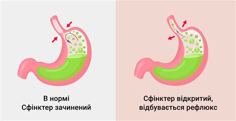 Симптомы эзофагита