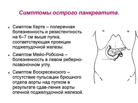 Симптом Мейо-Робсона: всё, что нужно знать об этом состоянии