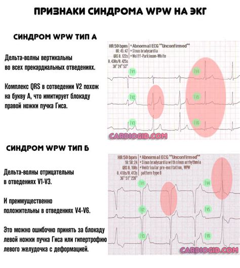 Синдром ВПВ и опасные препараты