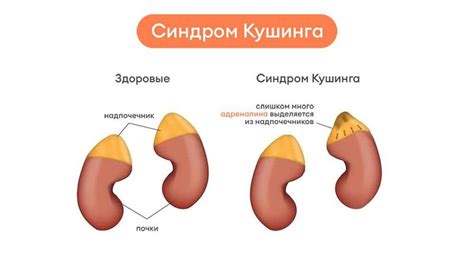 Синдром Кушинга: диагностика, терапия и специалисты