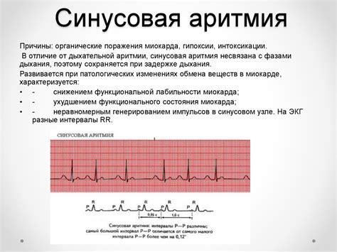 Синусовый ритм - ключевая роль