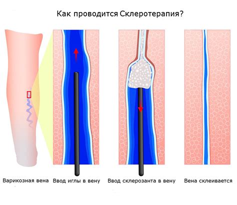 Склеротерапия