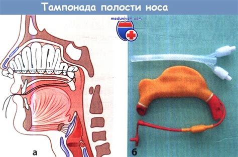 Советы по быстрой остановке носовой крови