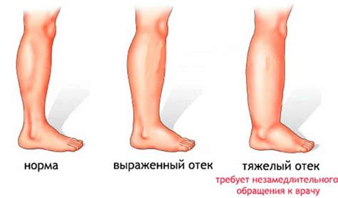 Советы по профилактике отекания ног у мужчины