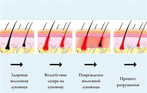 Солярий как причина длительного воспаления после процедур удаления волос