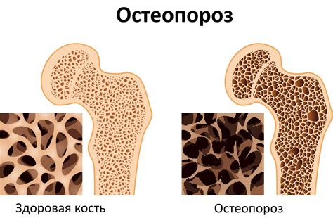 Старение и остеопороз