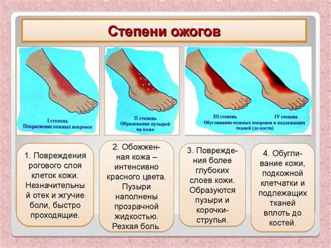 Типичные ошибки при ожогах: что нельзя делать