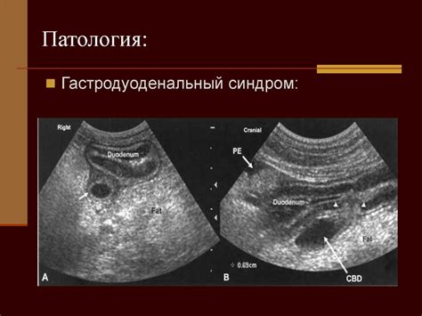 Ультразвуковое исследование желчного пузыря