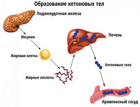 Уровень кетоновых тел в моче