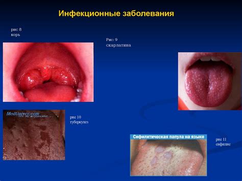 Хронические заболевания слизистой оболочки