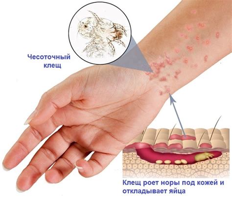 Чесотка и её признаки