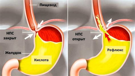 Что такое желчный рефлюкс