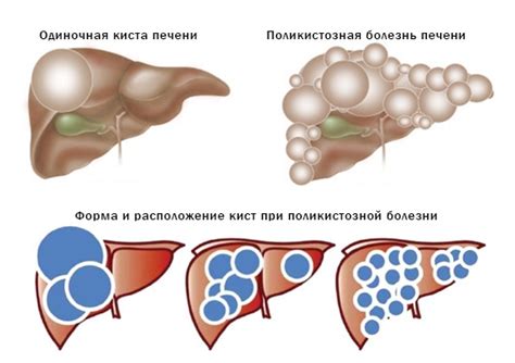 Что такое зашлакованность печени?