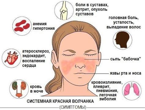 Что такое красная волчанка у мужчин?