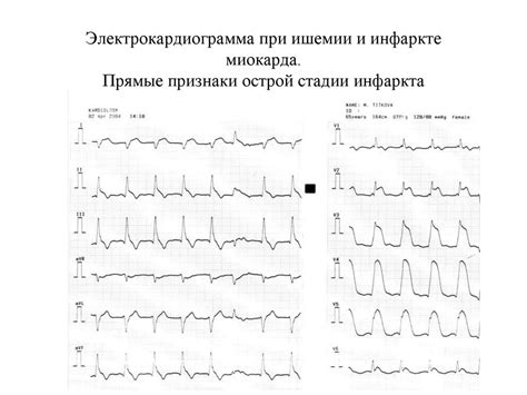 Электрокардиограмма при повышенной температуре