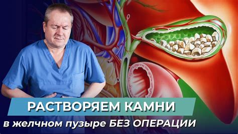 Эффективность методов улучшения желчеотделения при наличии камней в желчном пузыре