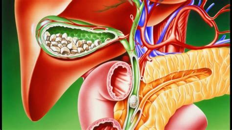  Что такое камни в поджелудочной железе 